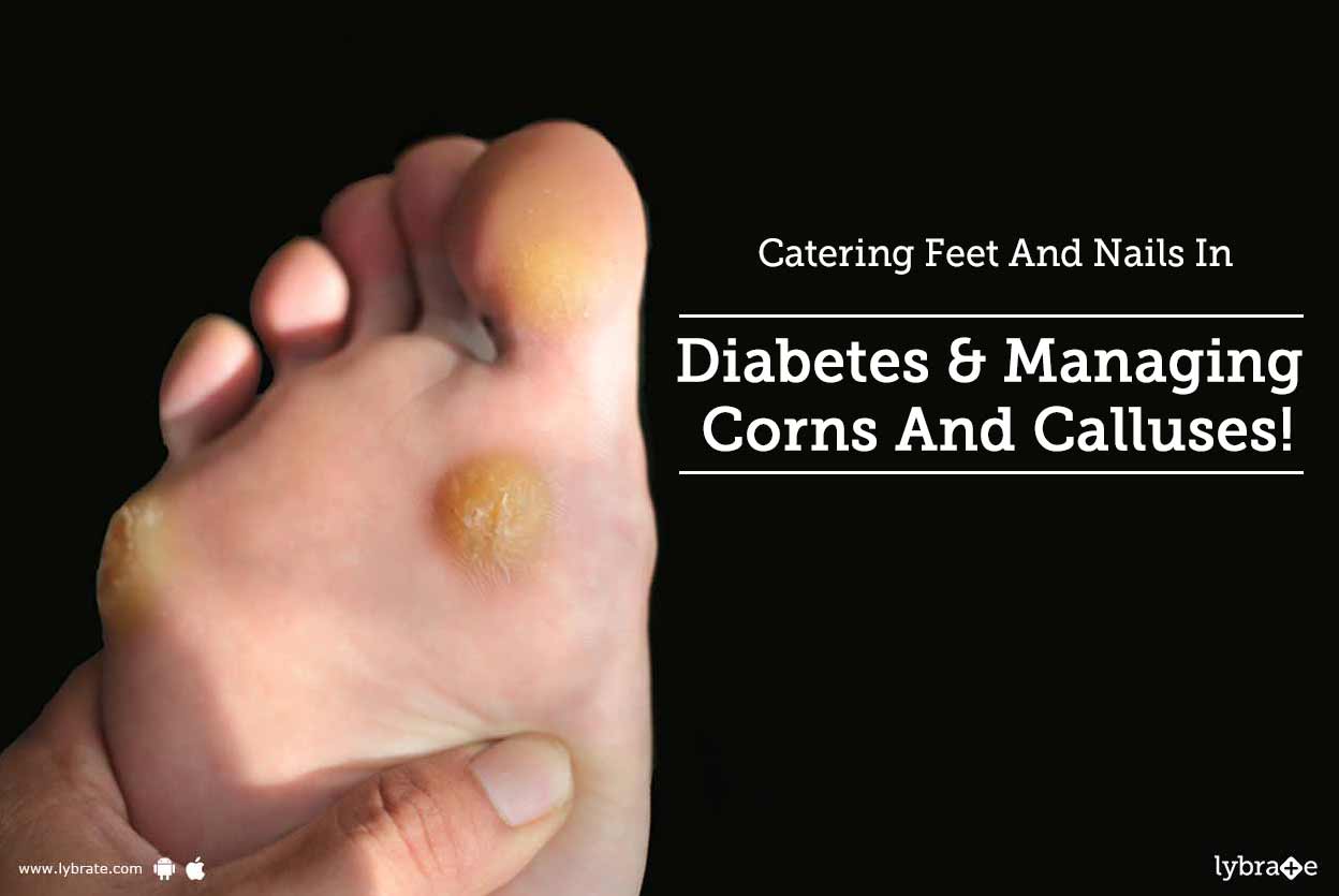 Catering Feet And Nails In Diabetes &  Managing Corns And ...