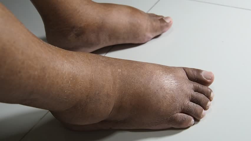 Diabetes And Swollen Feet And Ankles