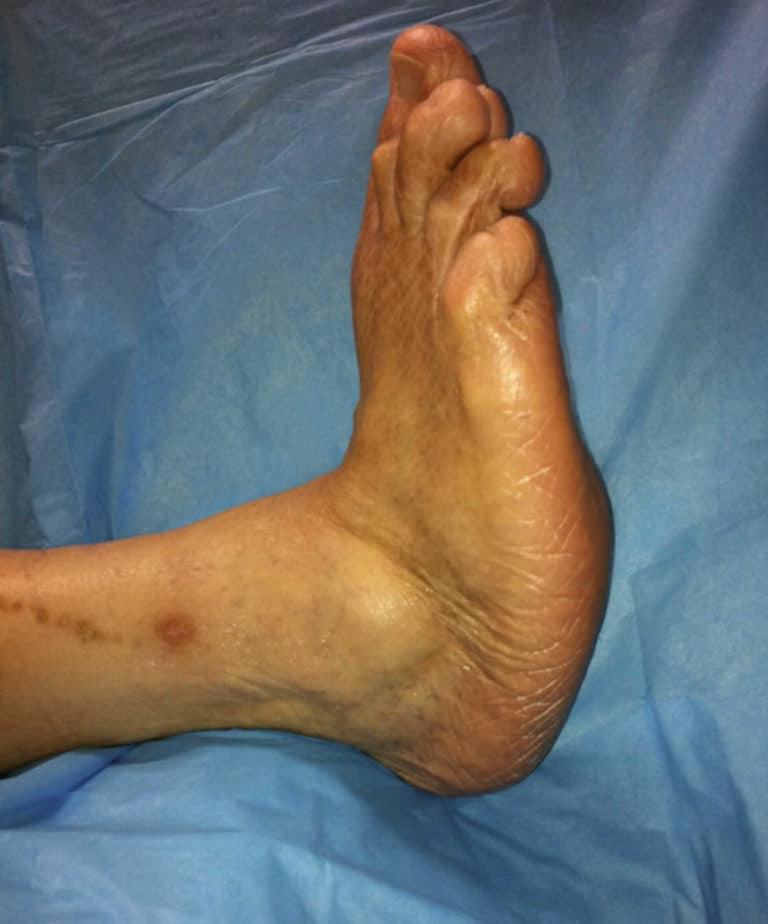 Diabetic foot problems, pain, ulcer, infection and diabetic foot treatment