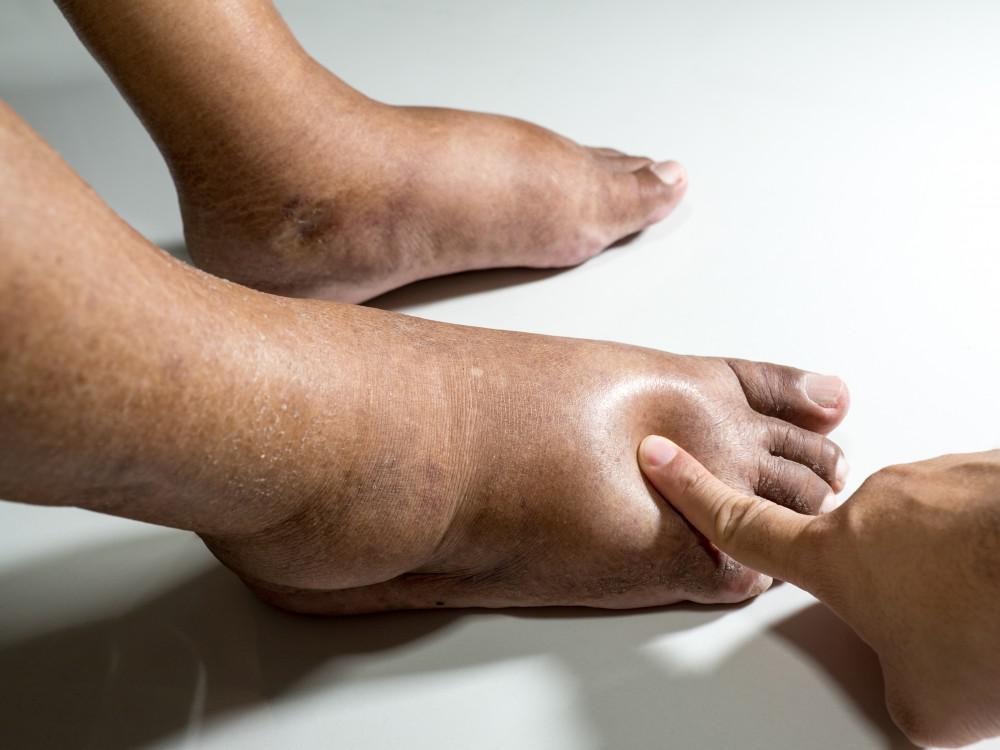 How Diabetes Affects Feet: Jennifer Tauber, DPM: Podiatrist