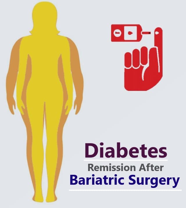 Weight Loss Surgery: Is It a Cure For Diabetes? Mexico Bariatric Center