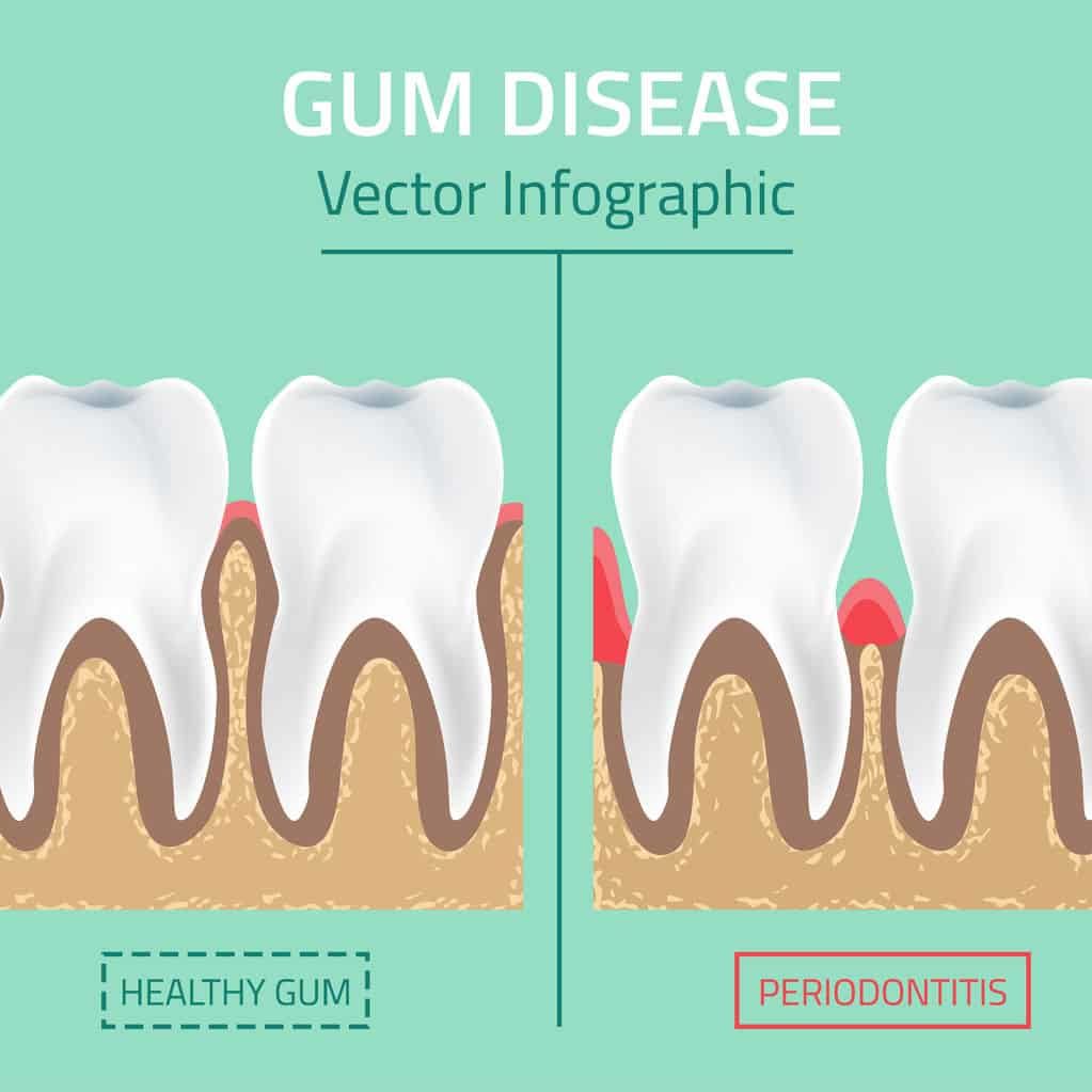 What About Gum Disease?